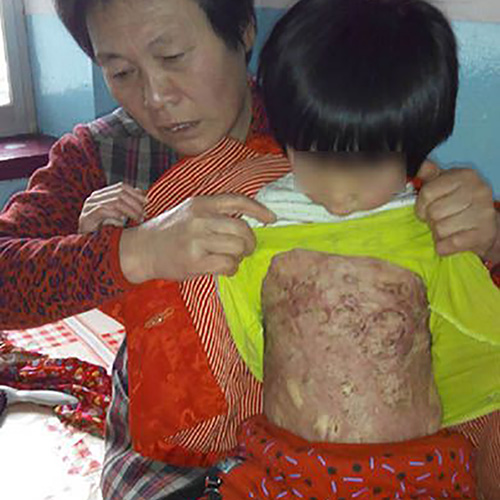 4歲女童王妤心不慎被爐上的開水嚴重燙傷，受傷面積達40%